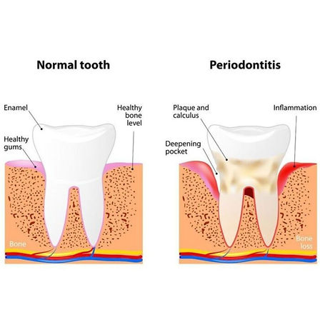 Periodontist Near Me in Pimple Saudagar - DENTALK®