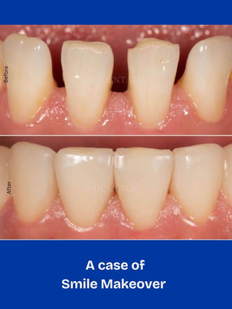 Smile makeover before after cosmetic dentistry near me Pimple Saudagar Pune DENTALK Speciality Dental Clinic Dr Samiksha Jarde