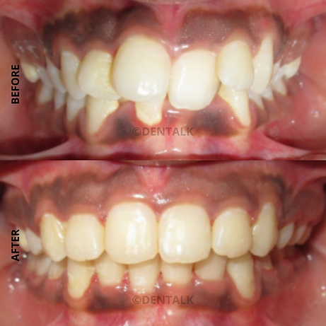 Best Orthodontic Braces Treatment in Pimple Saudagar - Get a Straighter Smile at DENTALK®