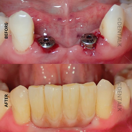 Dental Implants Specialist Near Me in Pimple Saudagar - DENTALK®