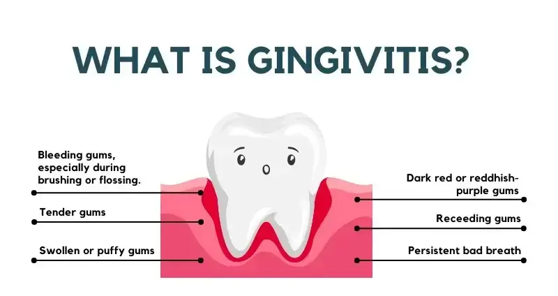 Understanding Gingivitis: The image illustrates common symptoms, including bleeding gums during brushing or flossing, tender and swollen gums, dark red or purple discoloration, receding gums, and persistent bad breath.