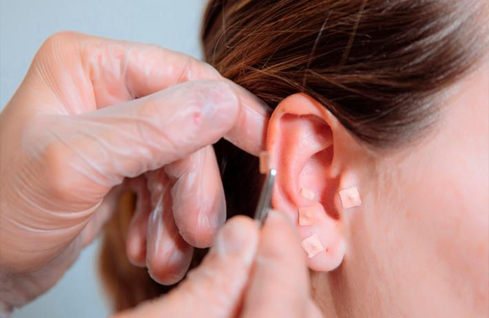 AURICULOTERAPIA
