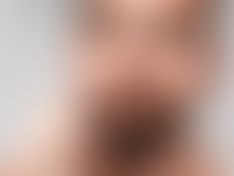  Beard Hair Transplant in Dubai