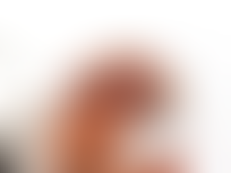 How Does a Hair Transplant Work for Hair Restoration?