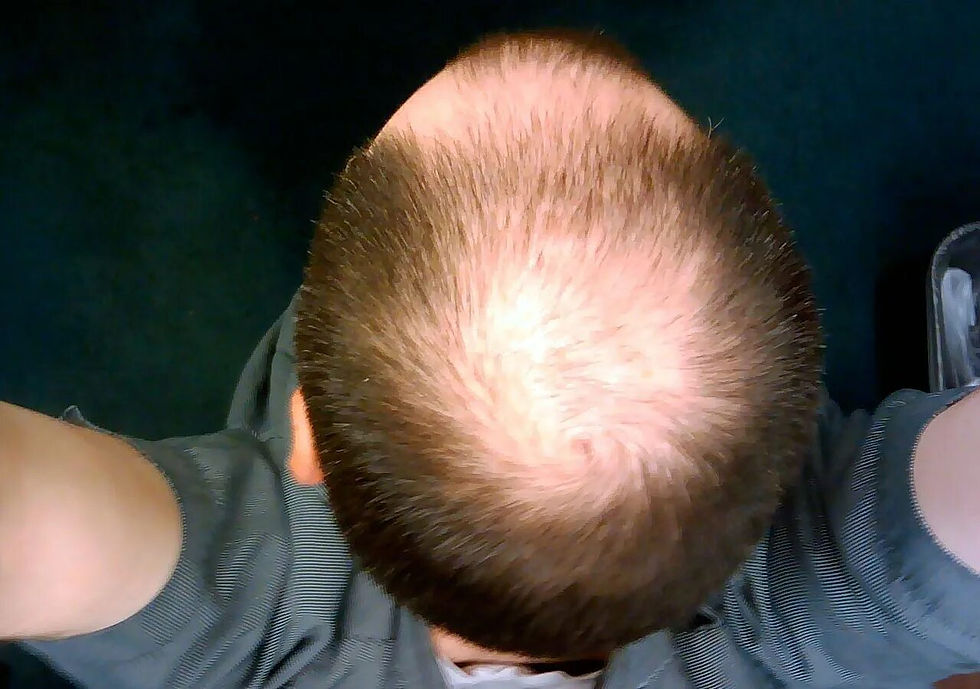 Is Crown Hair Transplant Safe for Sensitive Scalp Skin?