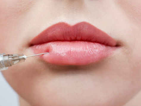 Can Belotero Fillers Help With Lip Definition?