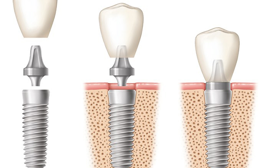 implants.png