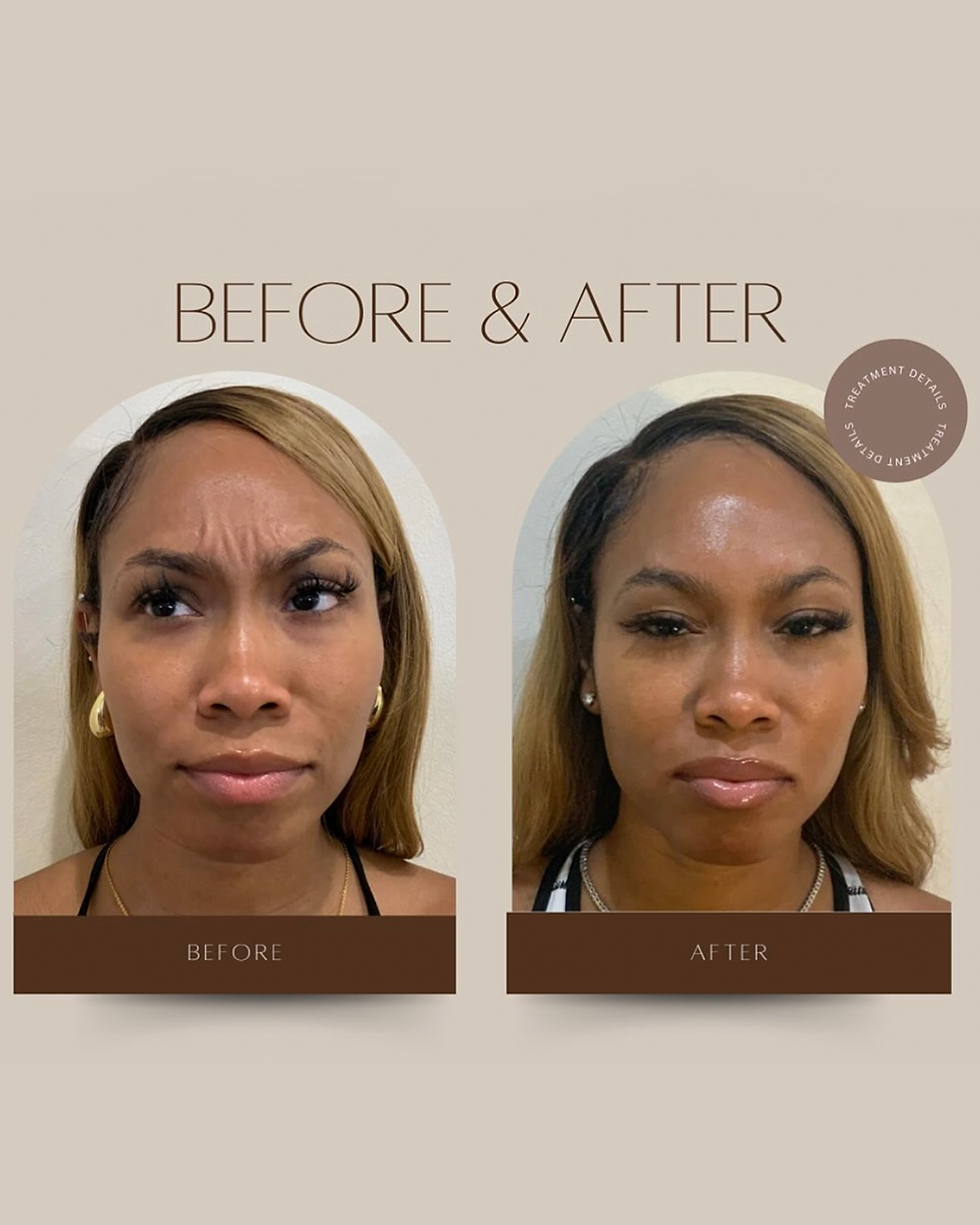 botox transformation_.png