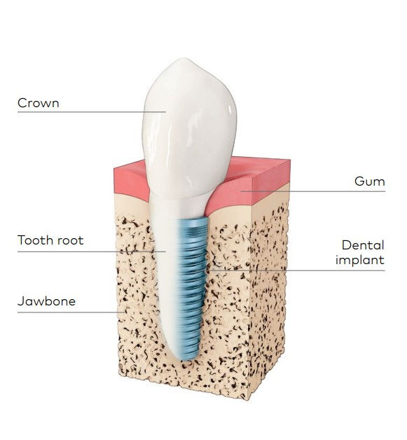 dental implant breakdown diagram.jpg
