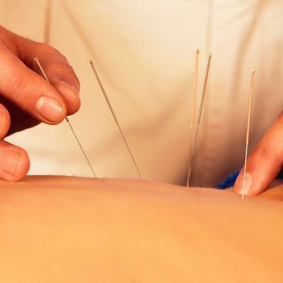 Mulher se tratando com acupuntura