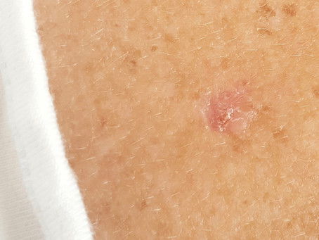 Black Salve Worked For Me