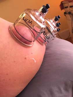 cupping.jpg