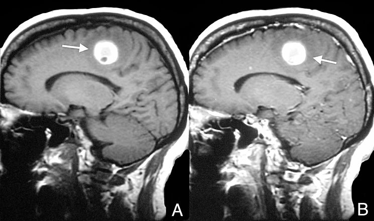 tc neoplasia maligna - hipermidia_edited.jpg