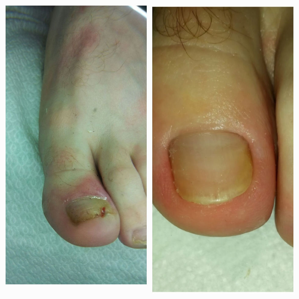 ציפורן חודרנית