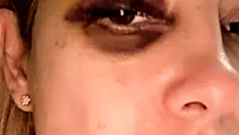 O “olho roxo” da ex-primeira-dama argentina é a marca da covardia com as mulheres, por Carlos Wagner*