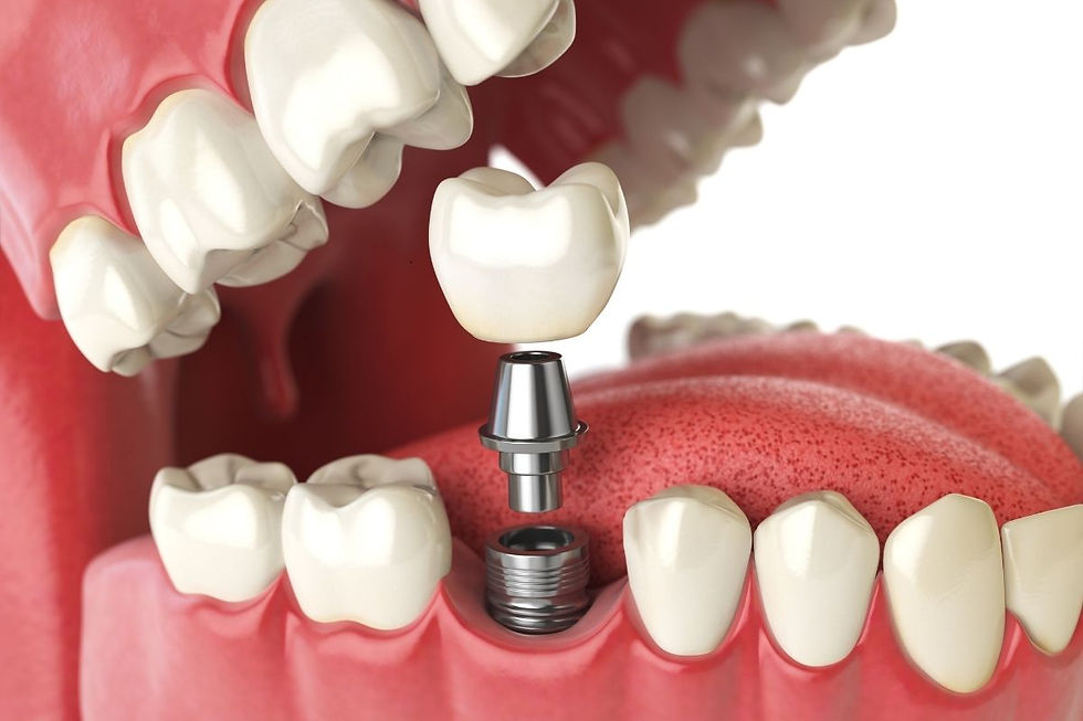 Dental crowns in Chandler