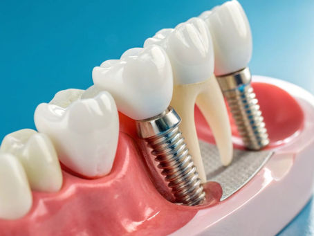 Dental Implant Aftercare Tips for Faster Healing