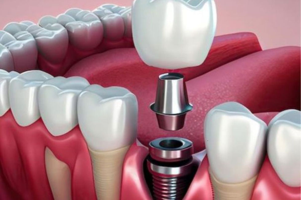 Dental Implants Chandler