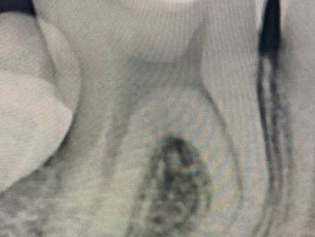 Complex lower molar root canal therapy with double curvature canals.