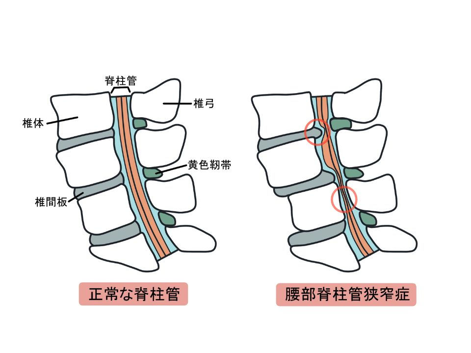 脊柱管狭窄症(比較)