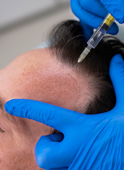 man-getting-hair-loss-treatment.jpg