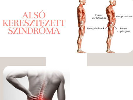 Keresztezett Szindrómák 2. rész – Az Alsó Keresztezett Szindróma és a Derékfájdalom
