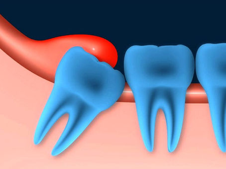 ¿QUE ES LA PERICORONITIS? 