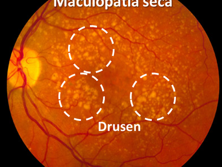 What is Dry Age-Related Macular Degeneration and How Can Photobiomodulation Help?