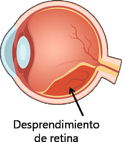 Desprendimiento de retina
