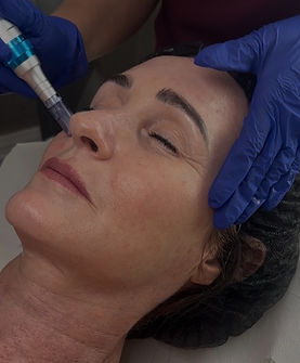 Aesthetic practitioner performing a microneedling facial