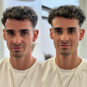 Cheek filler before and after in Manchester improving mid-face support with soft, natural-looking results