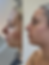 Non surgical nose filler treatment in Manchester to enhance nose shape and profile