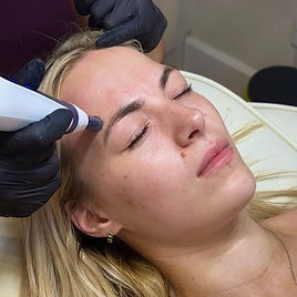 WEB Microneedling katie2 .jpeg