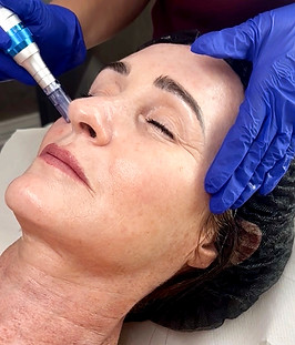 vampire facial_edited_edited.jpg