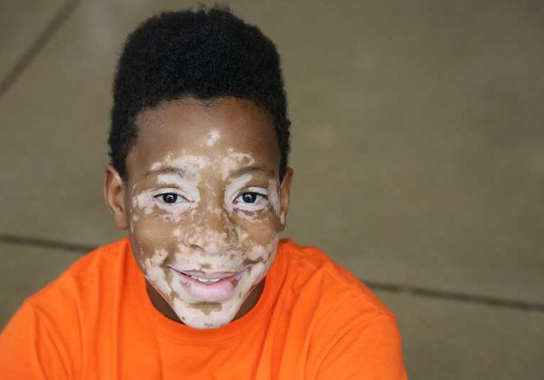 Vitiligo in Children Early Signs, Causes, and Treatment