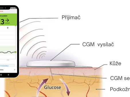 Schéma zobrazující fungování CGM senzoru pro měření glukózy – senzor je zaveden pod kůži do podkožního tuku, kde monitoruje hladinu glukózy a bezdrátově odesílá data do přijímače nebo mobilního telefonu.