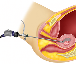 hysteroscopy-dramrita-kesari.png