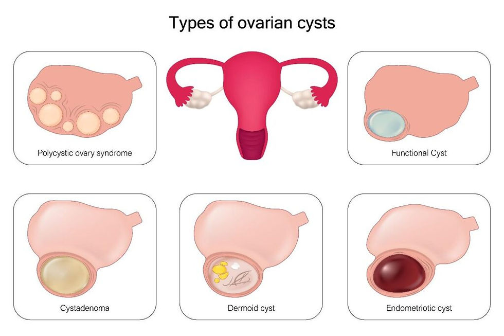 Close-up view of a medical illustration showing an ovary with cysts