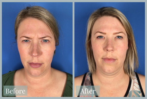 Before and after image of a blonde woman demonstrating the effects of Botox Cosmetic