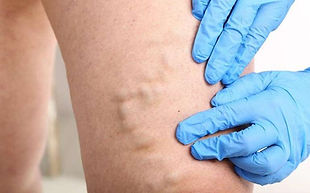 endovenous-laser-ablation.jpg