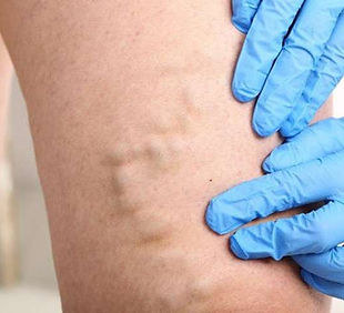 endovenous-laser-ablation.jpg