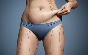 laser-lipolysis-1.jpg