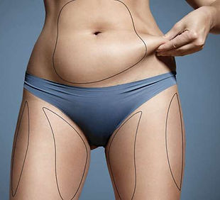laser-lipolysis-1.jpg