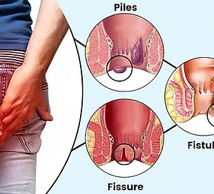 Piles-Fistula-Fissure.jpg