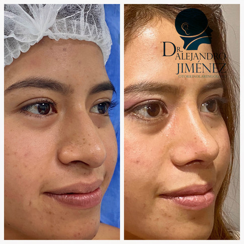 Rinoplastia estetica y funcional