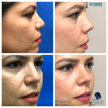 Rinoplastia estetica y funcional