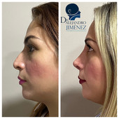 Rinoplastia estetica y funcional