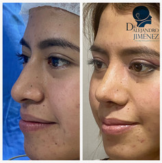 Rinoplastia estetica y funcional