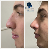 Rinoplastia estetica y funcional