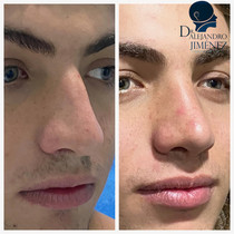 Rinoplastia estetica y funcional